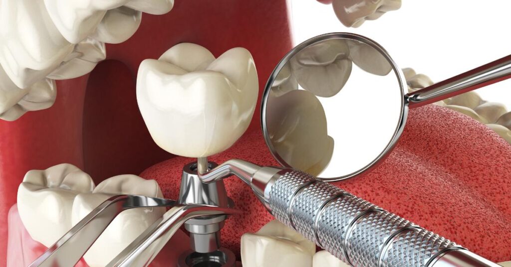 dental implants dentures