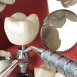 dental implants dentures