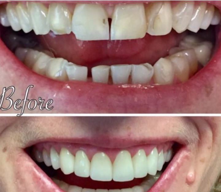 Dental Implants before And After