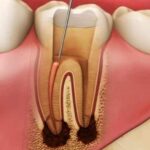 Root canal cost Toronto