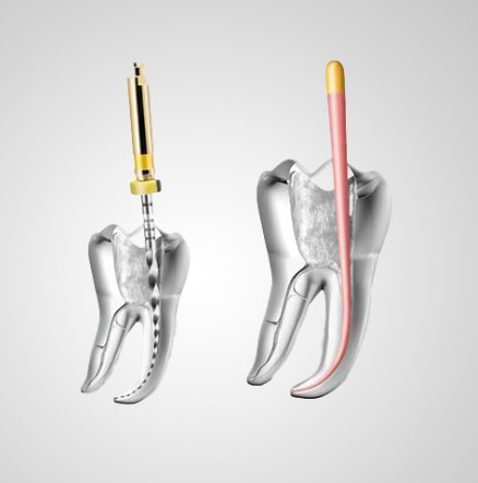 root canal cost calgary