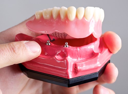 Implant Supported Dentures Cost