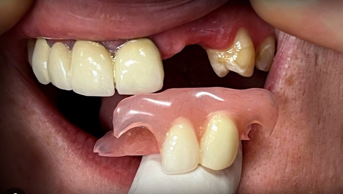 partial dentures for back teeth