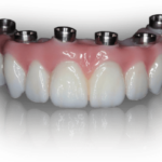 Hybrid implant denture