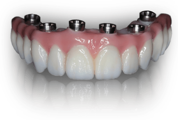 All On 4 Dental Implants Peridot Dental Care 