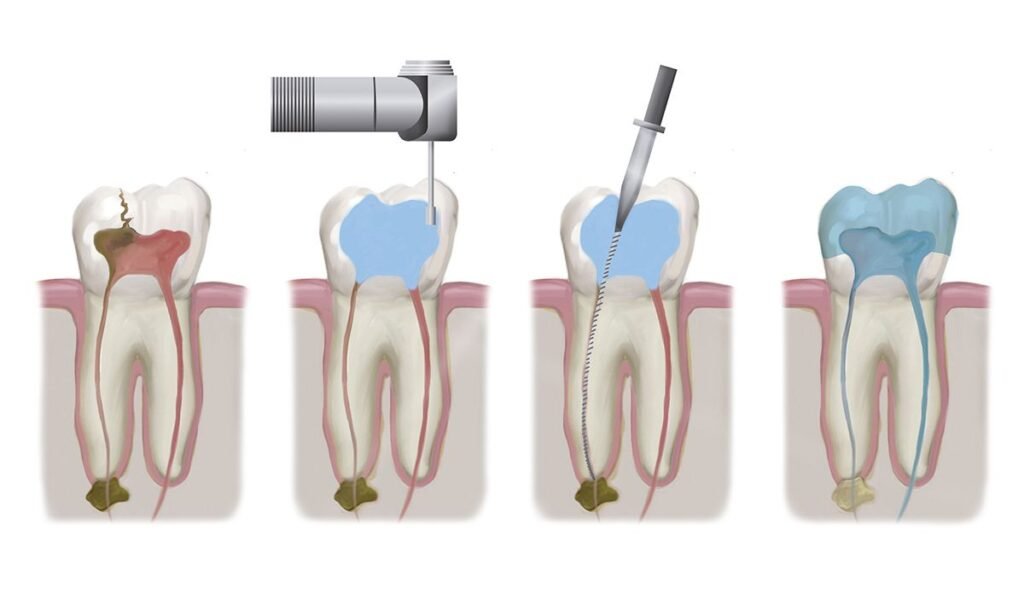 Illustration of the steps of root canal treatment