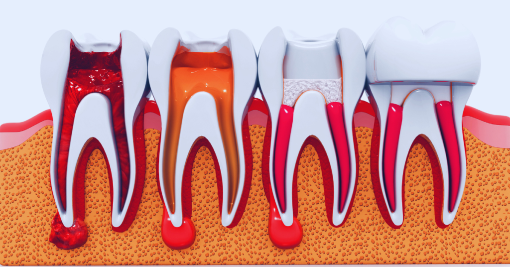 Illustration of an inflamed tooth nerve that needs endodontic treatment