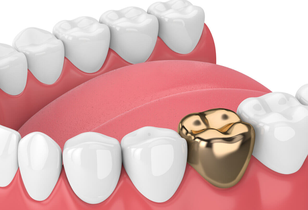 Gold Denture Teeth