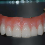 Hybrid Denture Cost