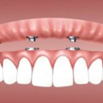 Problems With Snap in Dentures