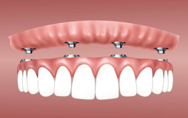 Problems With Snap in Dentures
