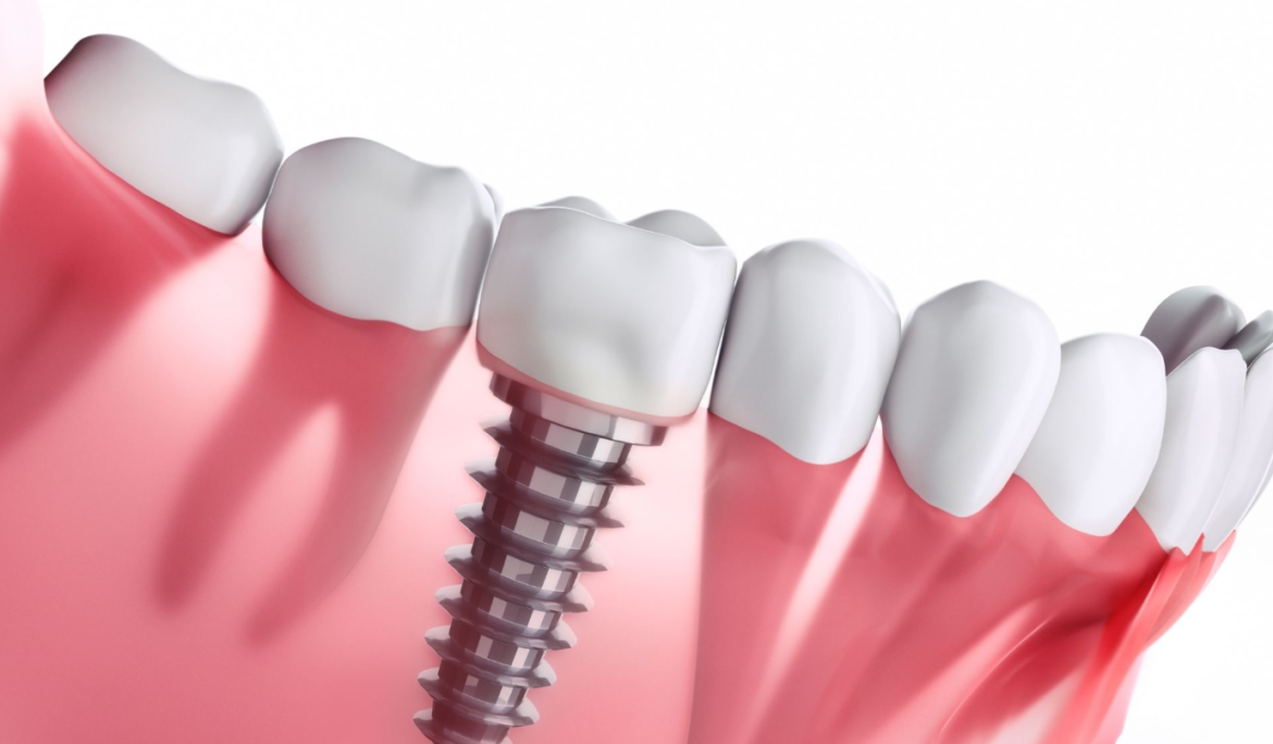 Cost of Dental Implants in Ontario