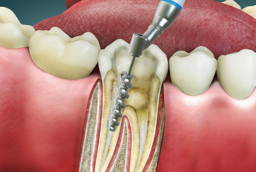 Root Canal in Woodbridge