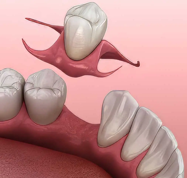 Single Tooth Partial Denture