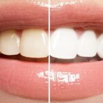 Teeth Whitening Before and After