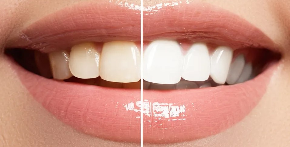 Teeth Whitening Before and After