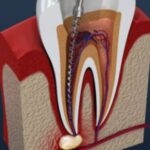 root canal