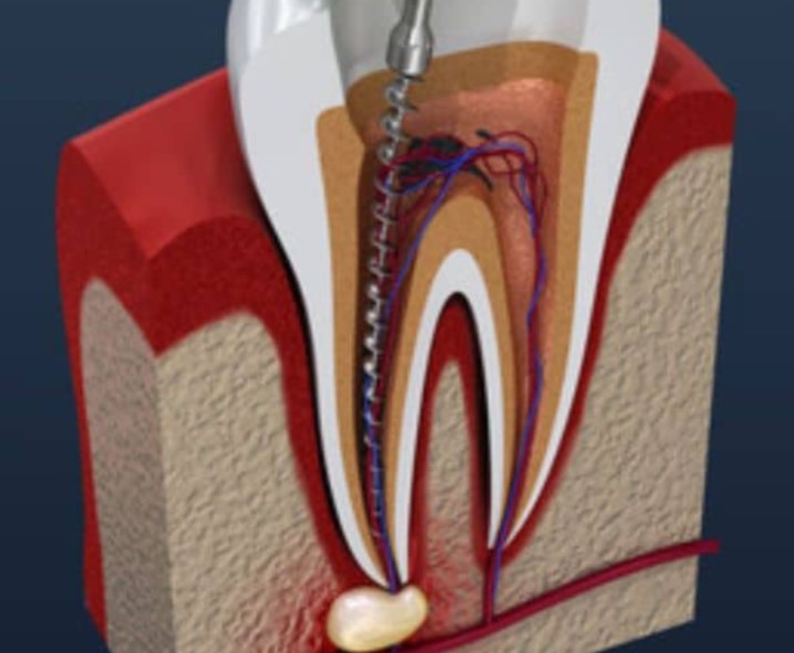 root canal