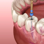 How do i know if i need a root canal?