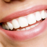 How Much Does Teeth Whitening Cost