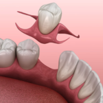 1 Tooth Partial Denture