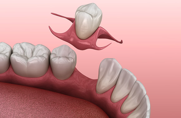 1 Tooth Partial Denture