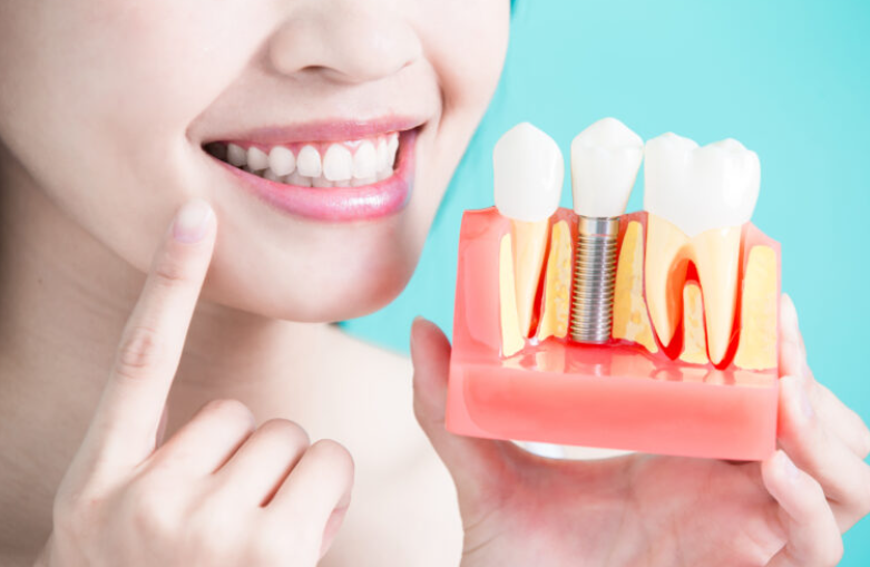 Dental Implants Cost Canada