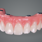 What Is A Hybrid Denture