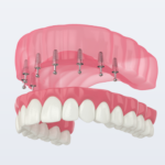 Upper denture implants