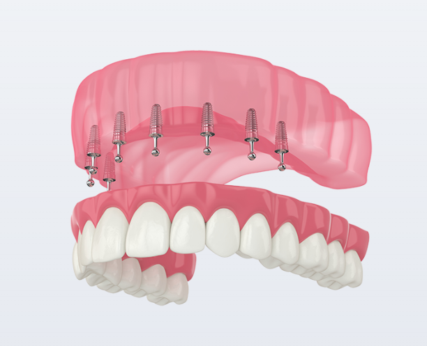 Upper denture implants