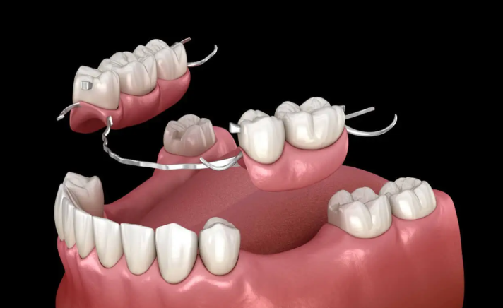 Partial dentures for upper back teeth