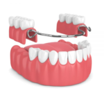 Permanent partial denture