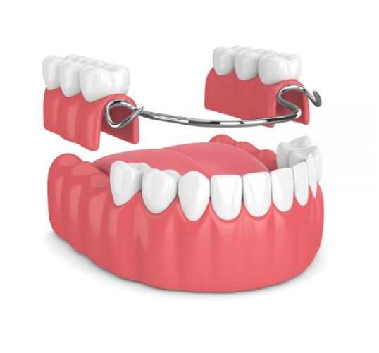 Permanent partial denture