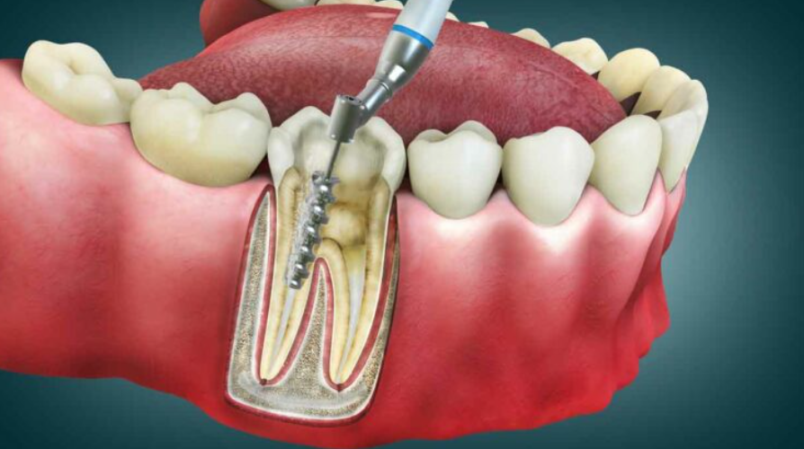 How to avoid root canal?