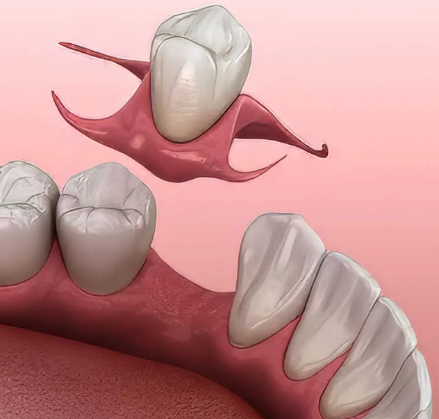 Partial dentures for front teeth