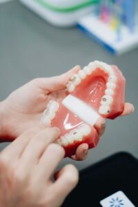 Orthodontic braces model used to explain braces comfort in Woodbridge