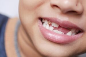 Child smiling with missing baby teeth as adult teeth come in