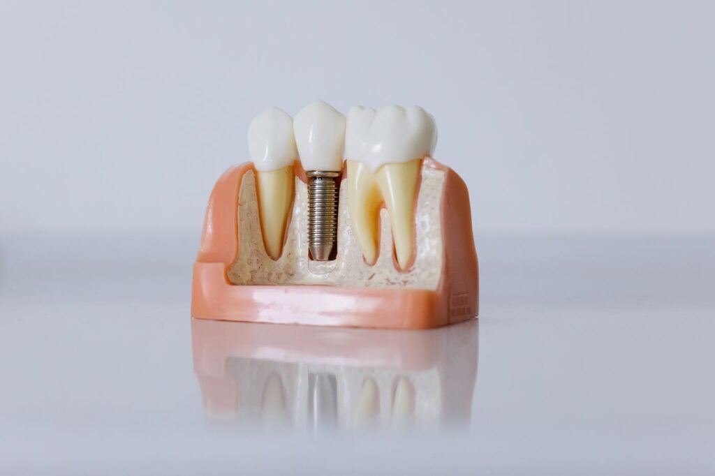 Dental implant model used to explain implant-supported dentures