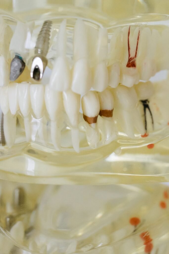Dental implant model with crowns used for patient education in Woodbridge