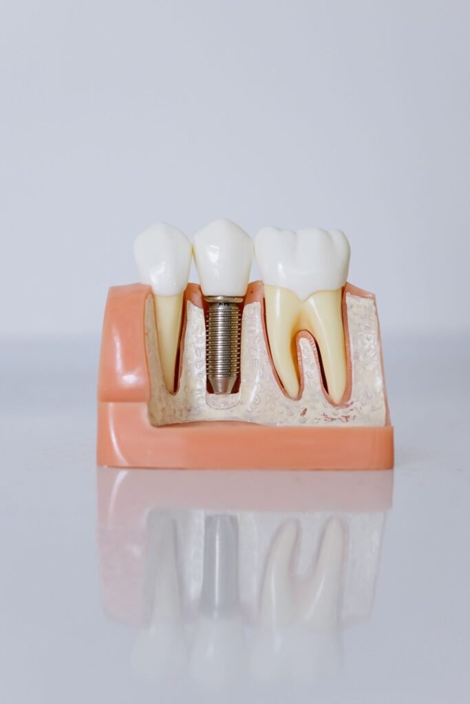 Dental implants in Woodbridge shown on a model at Peridot Dental Care