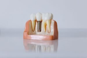 Close-up of a dental implant model showing the post, abutment and crown