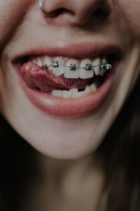 Smiling woman with orthodontic treatment to correct her bite