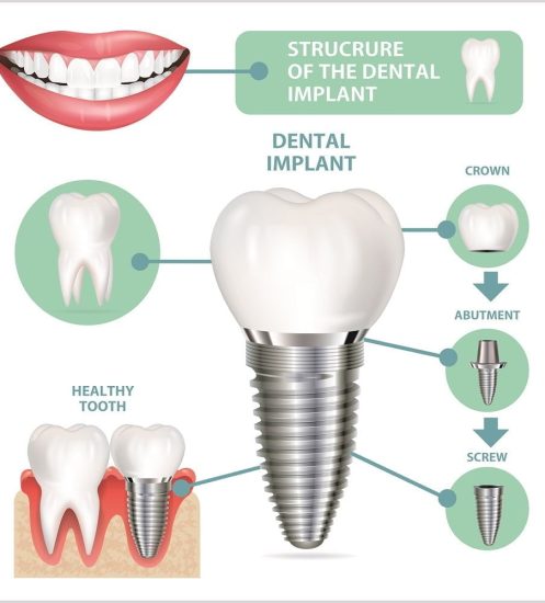 Dental-Implant-1000